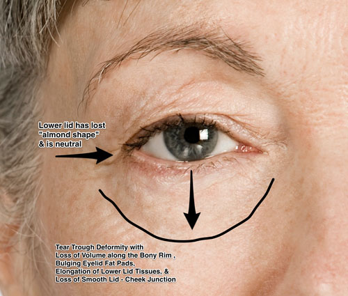 aged female lower eyelid
