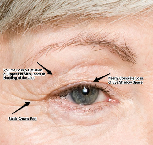 aged female upper eyelid