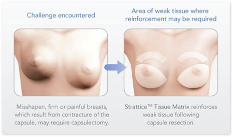 capsular contracture