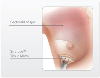 capsular contracture