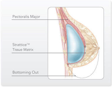 capsular contracture