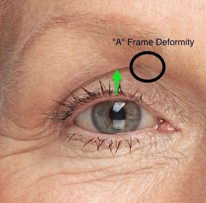 restora-austin-a-frame-deformity