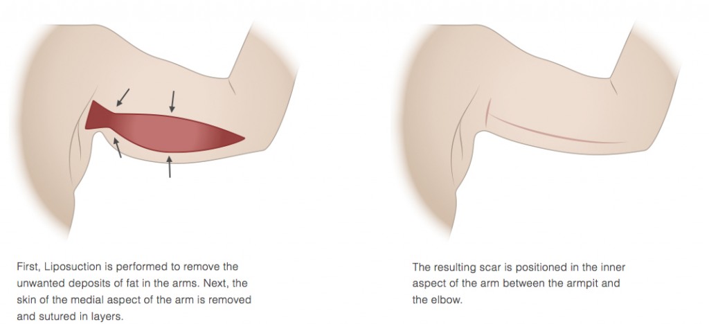 Brachioplasty Incisions