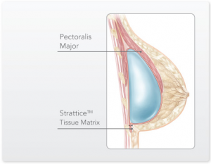 implantmal2