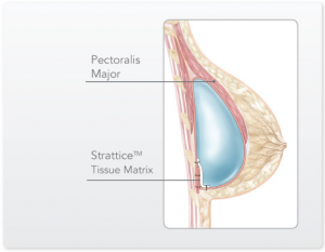 implantmal3