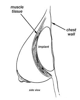 breast diagram - Restora Austin