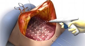 graphic showing hoe TissuGlu looks