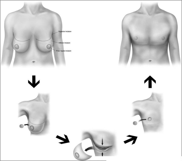 MTF Top Surgery, Austin  Dr. Reid - Restora Austin Plastic Surgery