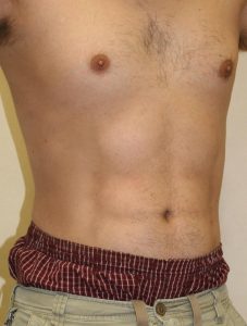 after vaser hi-def liposuction right view male patient