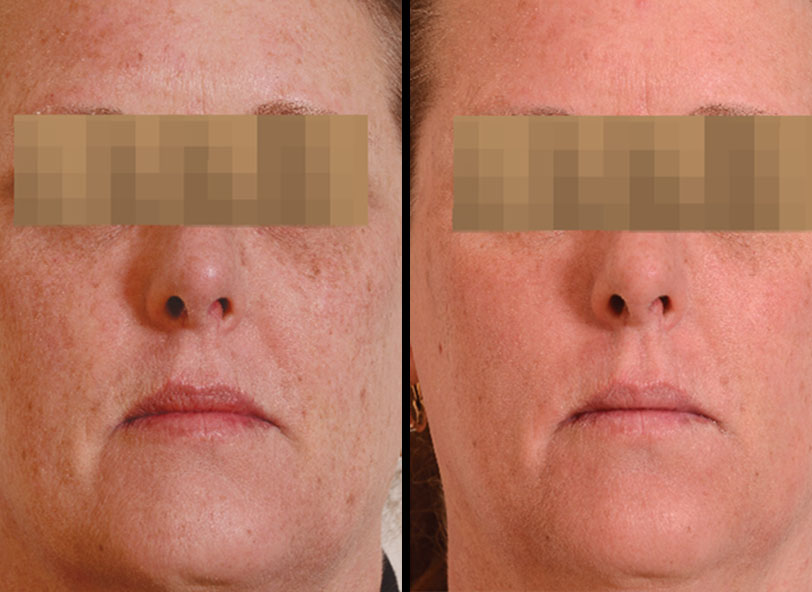 Pre and post-operative patient photo for Halo™ at Restora Austin Plastic Surgery Centre in Austin, TX