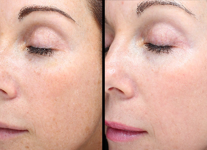 Patient before and after Halo treatment at Restora Austin Plastic Surgery Centre in Austin, TX