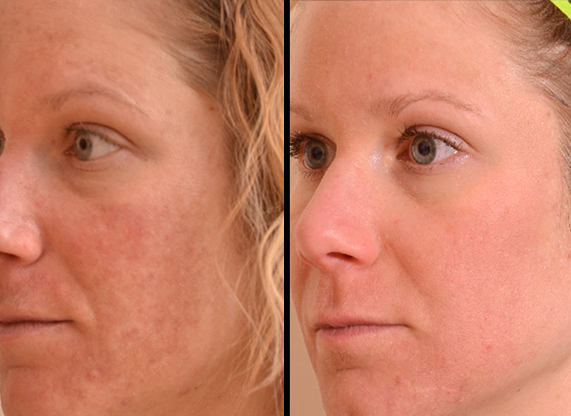 Pre and post-operative patient photo for Halo Treatment at Restora Austin Plastic Surgery Centre in Austin, TX