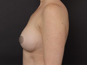 Patient after Motiva Preservé® at Restora Austin Plastic Surgery Centre in Austin, TX
