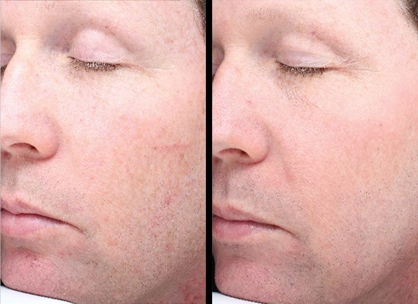 Pre and post-operative patient photo for Halo Skin Rejuvenation at Restora Austin Plastic Surgery Centre in Austin, TX