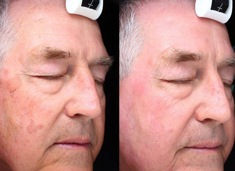 Patient before and afterHalo™ at Restora Austin Plastic Surgery Centre in Austin, TX