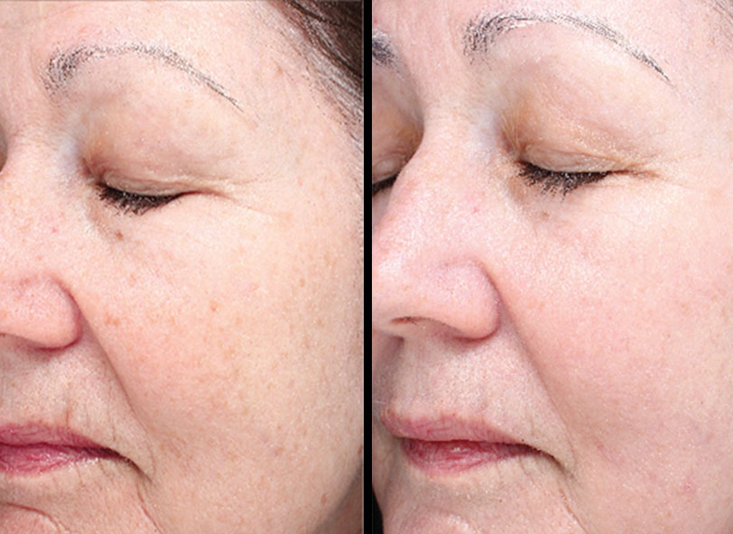 Patient before and after Halo Skin Rejuvenation at Restora Austin Plastic Surgery Centre in Austin, TX