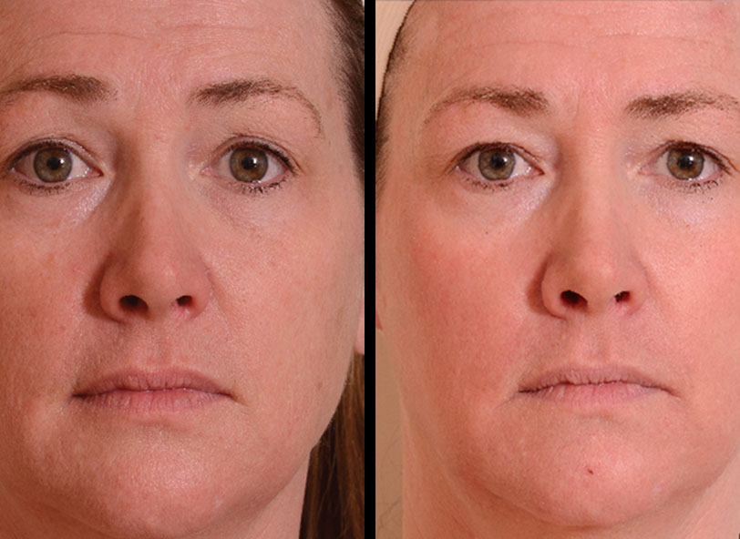Before and After Halo Skin Rejuvenation , Patient photo at Restora Austin Plastic Surgery Centre, Austin, TX