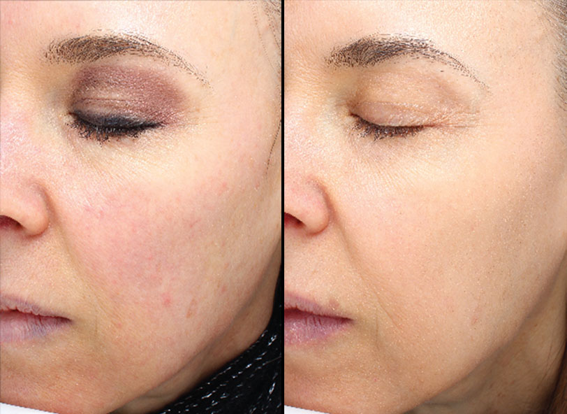 Before and After Halo™ , Patient photo at Restora Austin Plastic Surgery Centre, Austin, TX