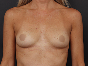 Patient before Motiva Breast Implant at Restora Austin Plastic Surgery Centre in Austin, TX