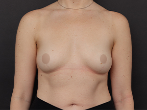 Pre-operative patient photo for Motiva Preservé® at Restora Austin Plastic Surgery Centre in Austin, TX