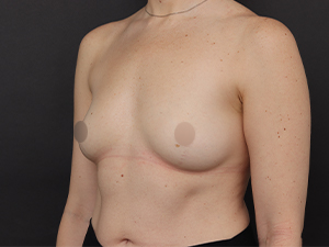 Before Motiva Preservé®procedure ,Patient photo at Restora Austin Plastic Surgery Centre, Austin, TX