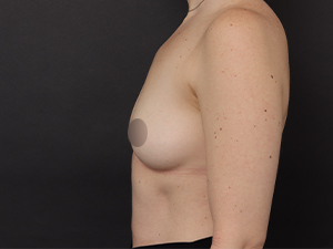 Patient before Motiva Preservé® at Restora Austin Plastic Surgery Centre in Austin, TX