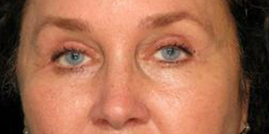 Patient after Eyelid Surgery at Restora Austin Plastic Surgery Centre in Austin, TX