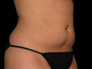 Patient before Safe Lipo at Restora Austin Plastic Surgery Centre in Austin, TX