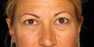 Before Eyelid Surgery , Patient photo at Restora Austin Plastic Surgery Centre, Austin, TX