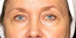Patient before Eyelid Surgery at Restora Austin Plastic Surgery Centre in Austin, TX