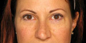 After Eyelid Surgery, Patient photo at Restora Austin Plastic Surgery Centre, Austin, TX