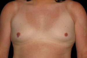Before MTF Top Surgery ,Patient photo at Restora Austin Plastic Surgery Centre, Austin, TX