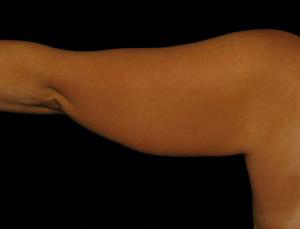 Before Arm Lift , Patient photo at Restora Austin Plastic Surgery Centre, Austin, TX