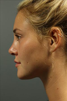 After Rhinoplasty, Patient photo at Restora Austin Plastic Surgery Centre, Austin, TX