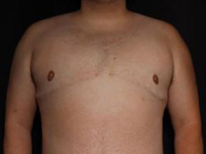 Patient after FTM Top Surgery at Restora Austin Plastic Surgery Centre in Austin, TX