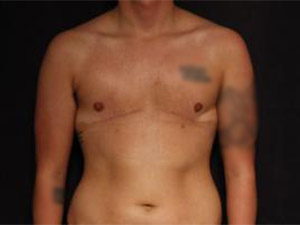 After FTM Top Surgery ,Patient photo at Restora Austin Plastic Surgery Centre, Austin, TX