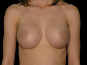 After Breast Augmentation ,Patient photo at Restora Austin Plastic Surgery Centre, Austin, TX