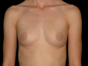 Before Breast Augmentation ,Patient photo at Restora Austin Plastic Surgery Centre, Austin, TX