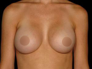 Patient after Breast Augmentation at Restora Austin Plastic Surgery Centre in Austin, TX