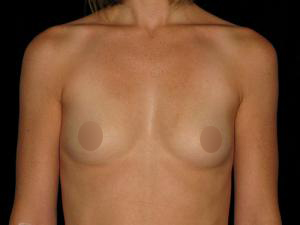 Patient before Breast Augmentation at Restora Austin Plastic Surgery Centre in Austin, TX