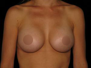 Post-operative patient photo for Breast Augmentation at Restora Austin Plastic Surgery Centre in Austin, TX
