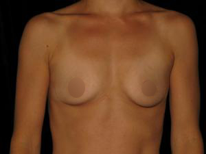 Pre-operative patient photo for Breast Augmentation at Restora Austin Plastic Surgery Centre in Austin, TX