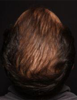 Patient after Hair Restoration at Restora Austin Plastic Surgery Centre in Austin, TX