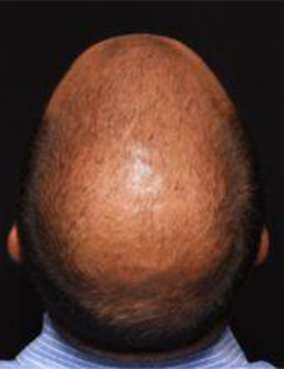 Patient before Hair Restoration at Restora Austin Plastic Surgery Centre in Austin, TX