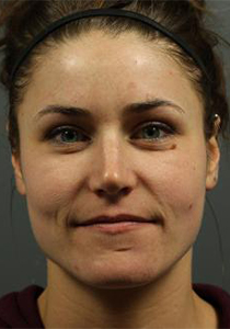 Before undergoing Neurotoxin , Patient photo at Restora Austin Plastic Surgery Centre, Austin, TX