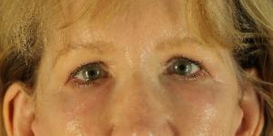 Post-operative patient photo for Eyelid Surgery at Restora Austin Plastic Surgery Centre in Austin, TX