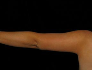 After Arm Lift ,Patient photo at Restora Austin Plastic Surgery Centre, Austin, TX