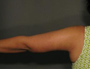 Patient after Arm Lift at Restora Austin Plastic Surgery Centre in Austin, TX