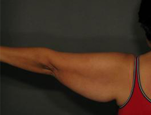 Patient before Arm Lift at Restora Austin Plastic Surgery Centre in Austin, TX