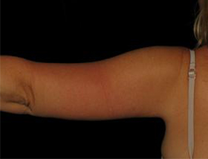 Post-operative patient photo for Arm Lift at Restora Austin Plastic Surgery Centre in Austin, TX